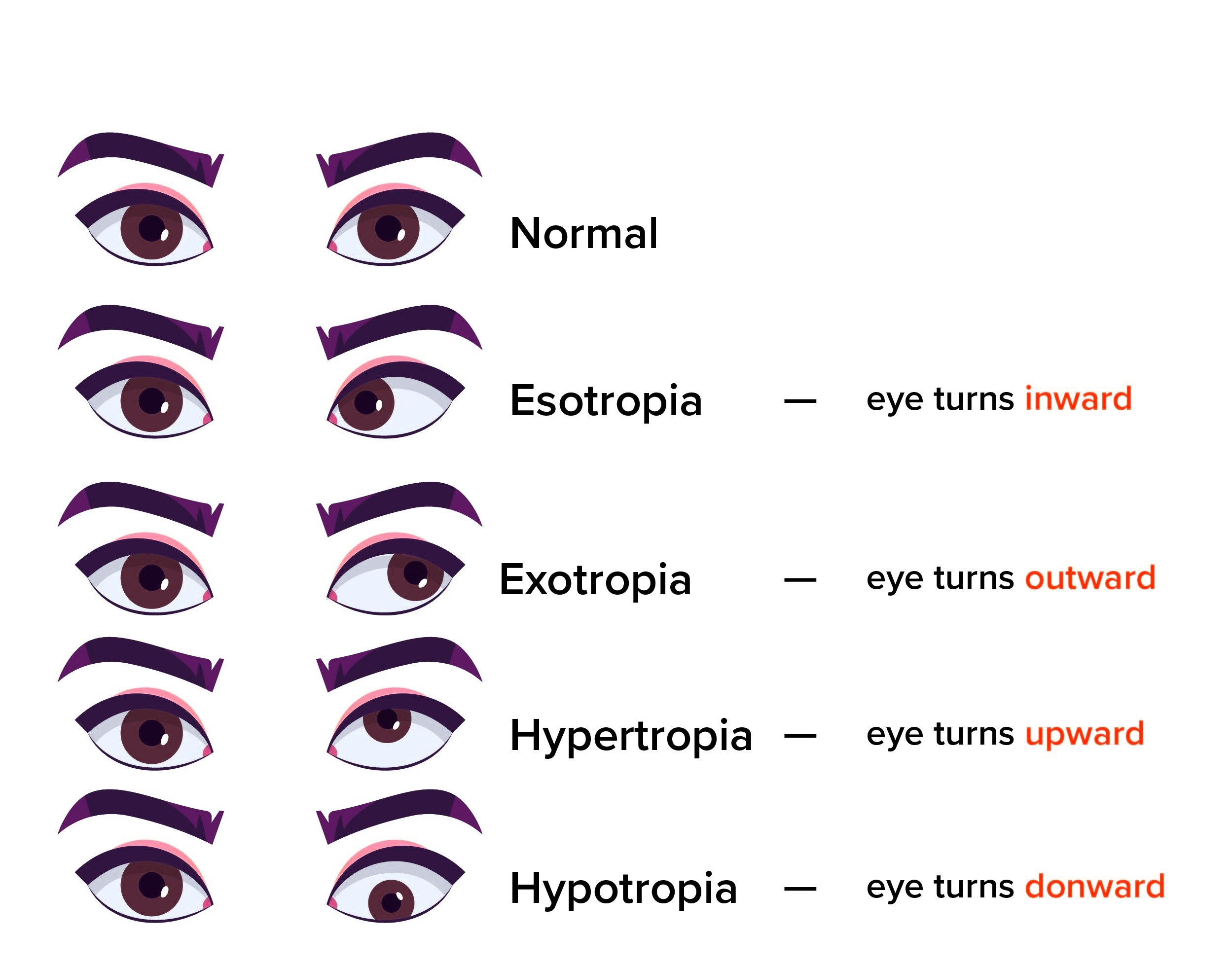 image alt types of Squint